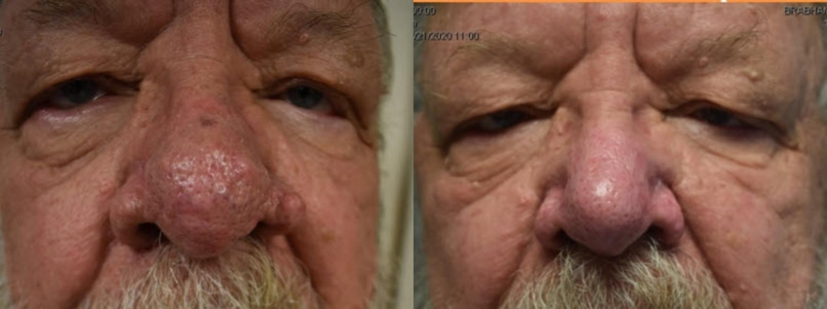 Nose Surgery Before & After Photo | San Francisco, CA | Kaiser Permanente Cosmetic Services