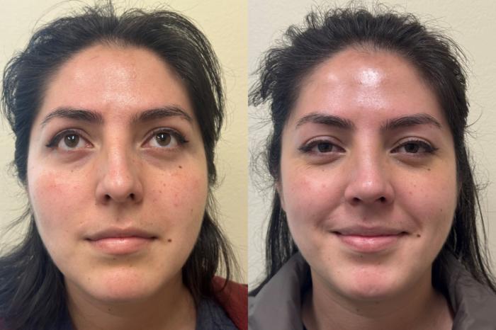 Nose Surgery Before & After Photo | San Francisco, CA | Kaiser Permanente Cosmetic Services