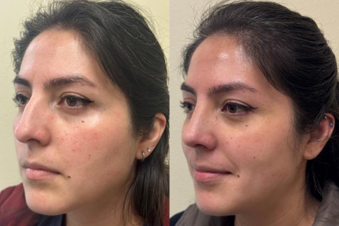 Nose Surgery Before & After Photo | San Francisco, CA | Kaiser Permanente Cosmetic Services