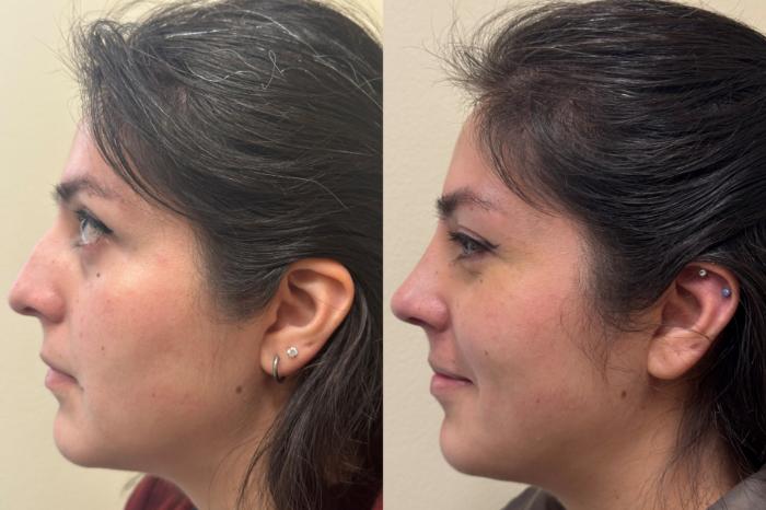 Nose Surgery Before & After Photo | San Francisco, CA | Kaiser Permanente Cosmetic Services