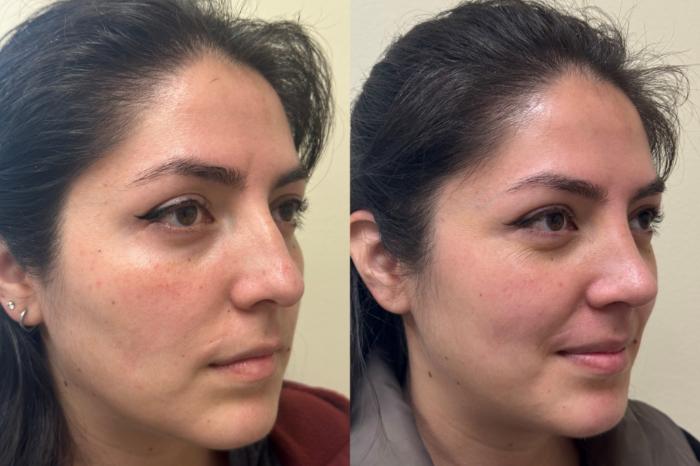 Nose Surgery Before & After Photo | San Francisco, CA | Kaiser Permanente Cosmetic Services