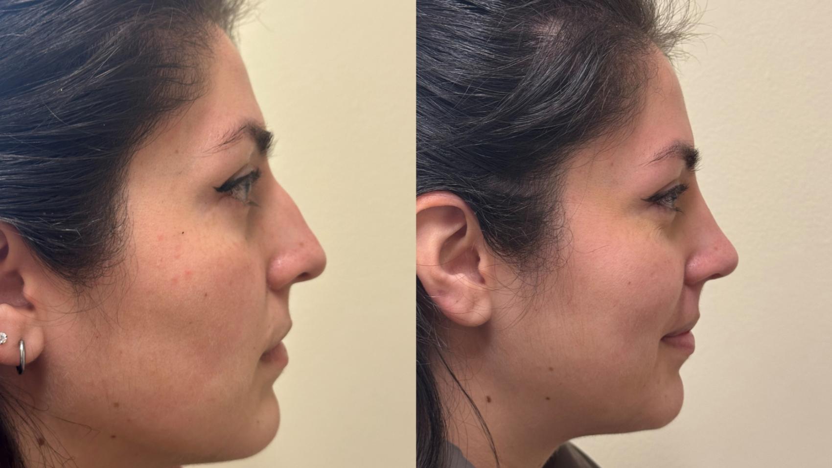 Nose Surgery Before & After Photo | San Francisco, CA | Kaiser Permanente Cosmetic Services