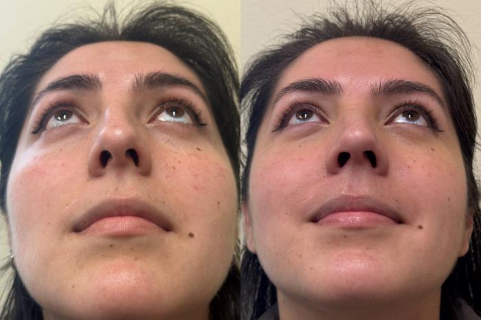 Nose Surgery Before & After Photo | San Francisco, CA | Kaiser Permanente Cosmetic Services