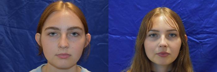 Nose Surgery Before & After Photo | San Francisco, CA | Kaiser Permanente Cosmetic Services