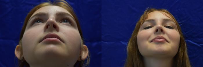 Nose Surgery Before & After Photo | San Francisco, CA | Kaiser Permanente Cosmetic Services