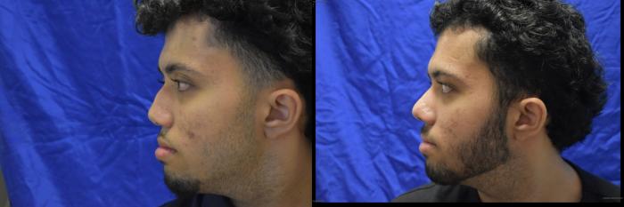 Nose Surgery Before & After Photo | San Francisco, CA | Kaiser Permanente Cosmetic Services
