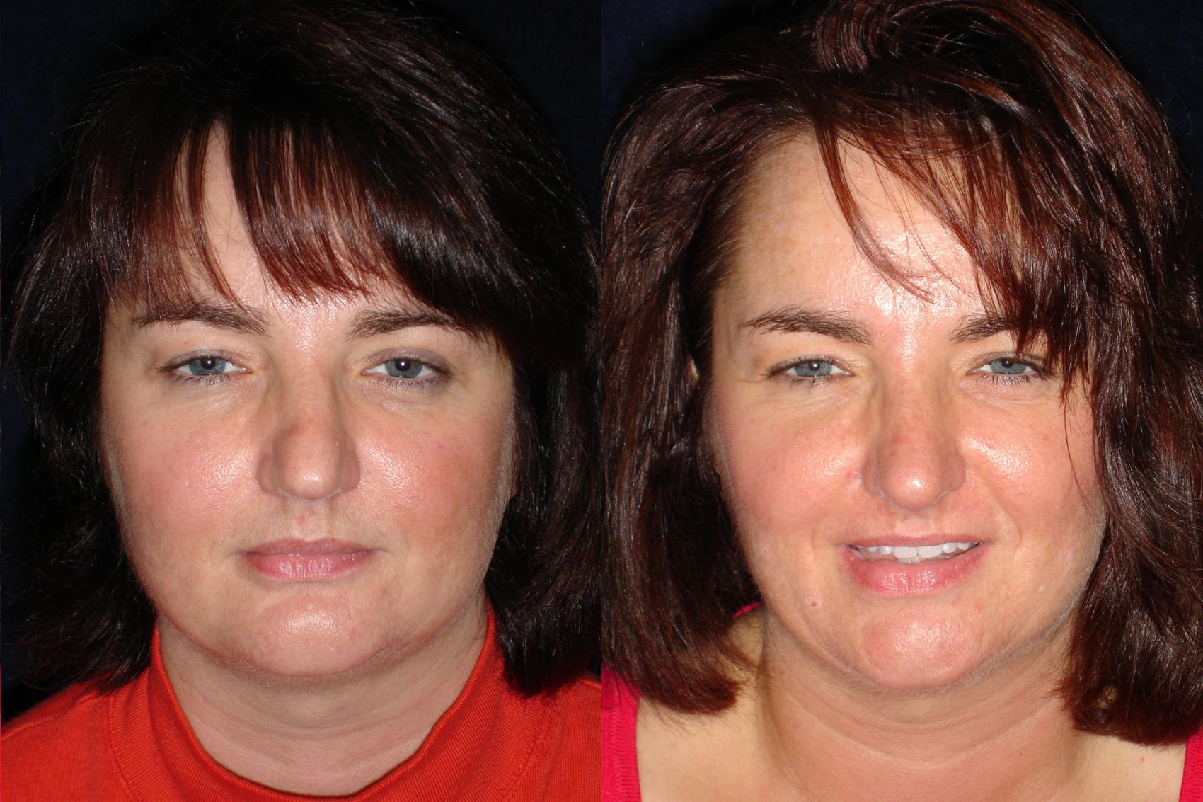 Nose Surgery Before & After Photos Patient 70 San Francisco, CA Kaiser Permanente Cosmetic