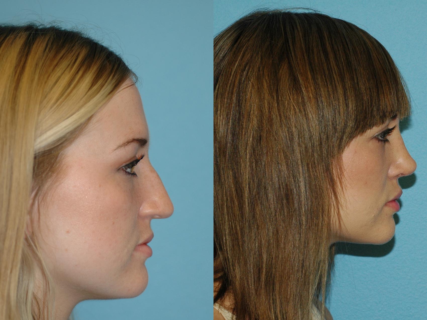 Nose Surgery Before & After Photos Patient 75 San Francisco, CA Kaiser Permanente Cosmetic