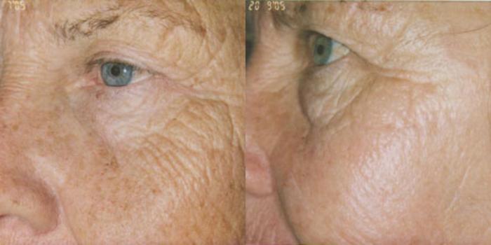 Obagi® Consultation Before & After Photo | San Francisco, CA | Kaiser Permanente Cosmetic Services