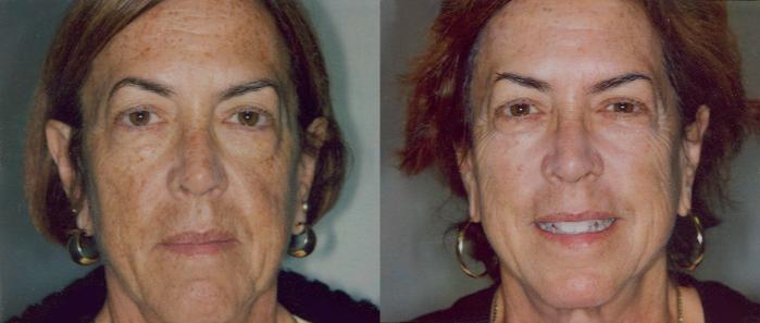 Obagi® Consultation Before & After Photo | San Francisco, CA | Kaiser Permanente Cosmetic Services