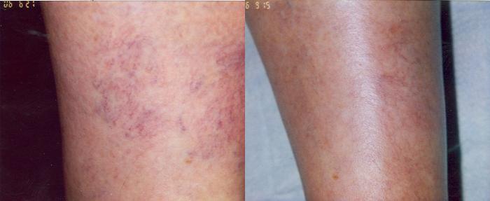 Sclerotherapy Before & After Photo | San Francisco, CA | Kaiser Permanente Cosmetic Services