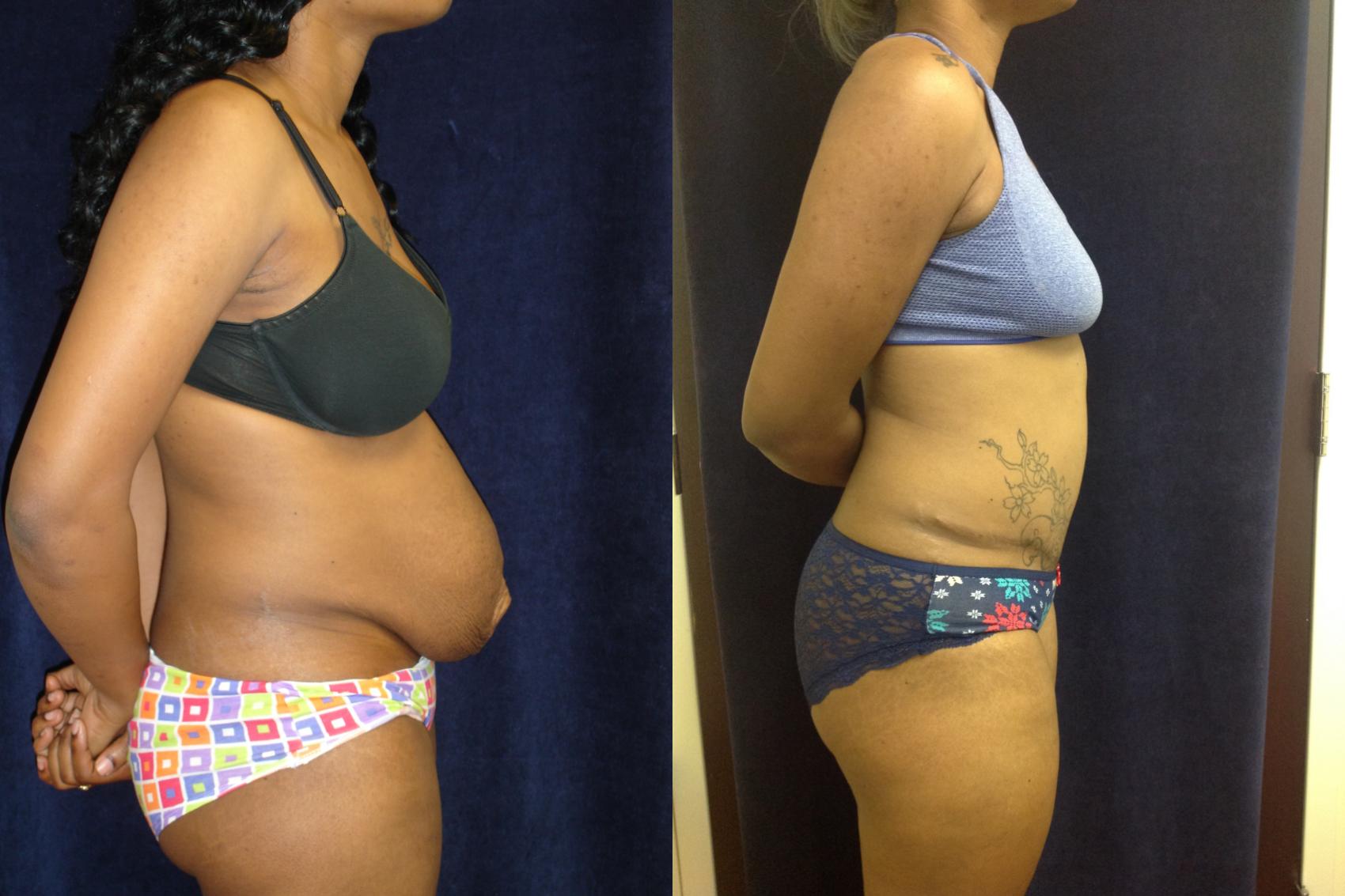 Tummy Tuck Before & After Photo | San Francisco, CA | Kaiser Permanente Cosmetic Services