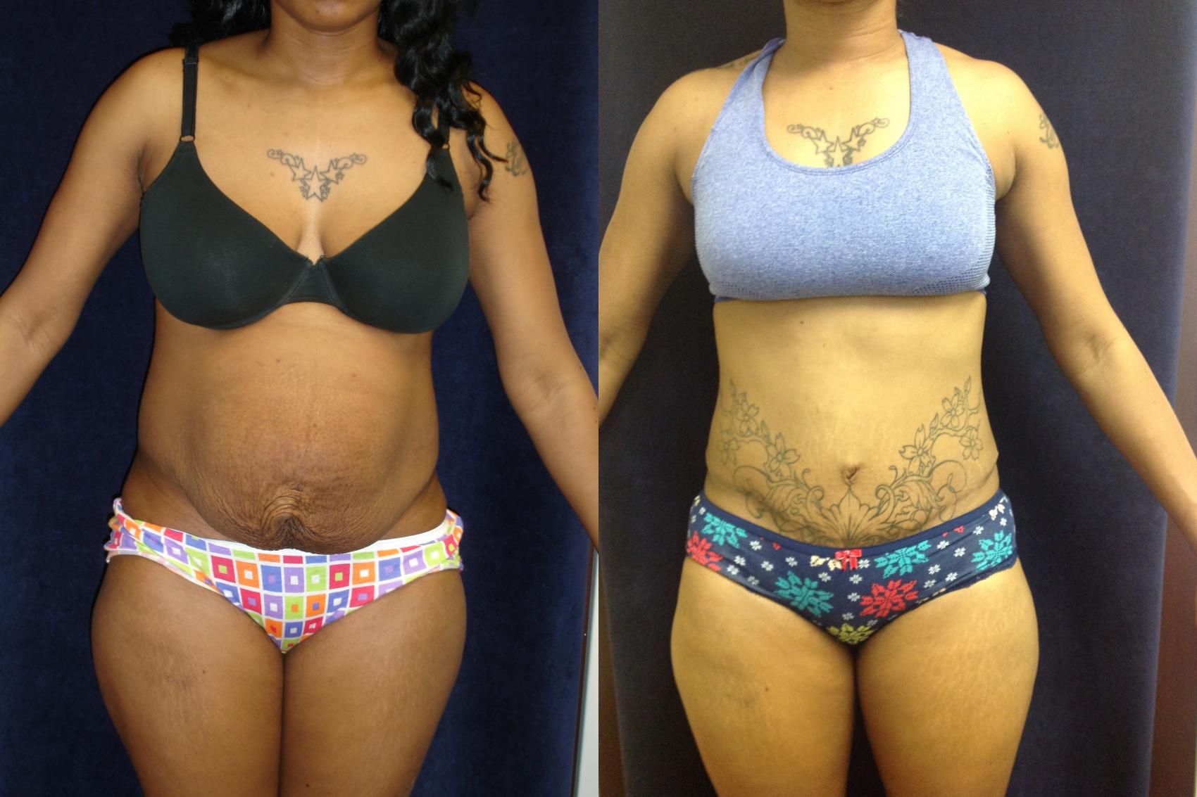 postpartum tummy tuck before and after