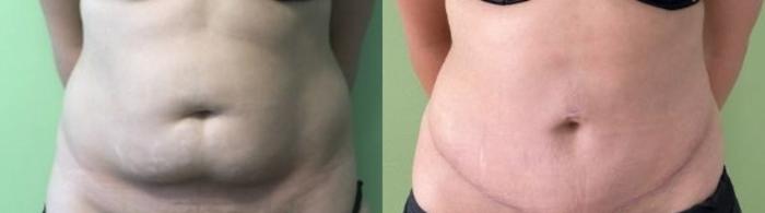 Tummy Tuck Before & After Photo | San Francisco, CA | Kaiser Permanente Cosmetic Services