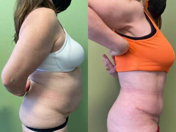Tummy Tuck Before & After Photo | San Francisco, CA | Kaiser Permanente Cosmetic Services