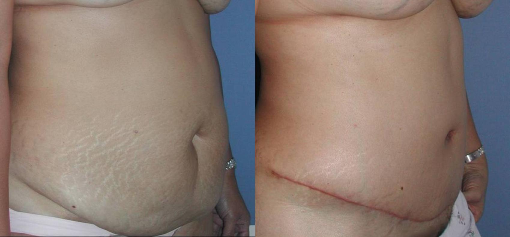 Tummy Tuck Before & After Photos Patient 33 San Francisco, CA Kaiser Permanente Cosmetic