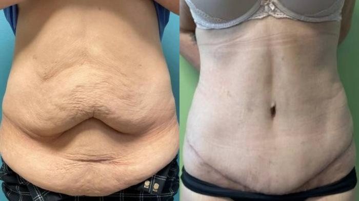 Tummy Tuck Before & After Photo | San Francisco, CA | Kaiser Permanente Cosmetic Services