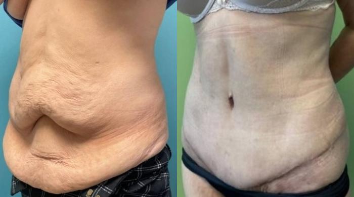 Tummy Tuck Before & After Photo | San Francisco, CA | Kaiser Permanente Cosmetic Services