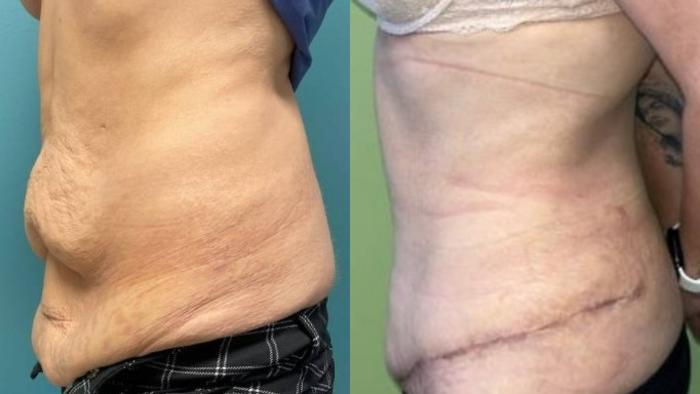 Tummy Tuck Before & After Photo | San Francisco, CA | Kaiser Permanente Cosmetic Services