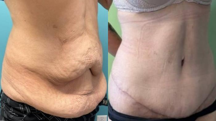 Tummy Tuck Before & After Photo | San Francisco, CA | Kaiser Permanente Cosmetic Services