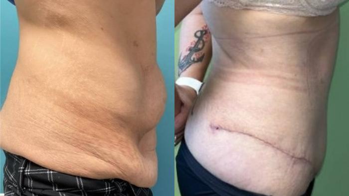 Tummy Tuck Before & After Photo | San Francisco, CA | Kaiser Permanente Cosmetic Services