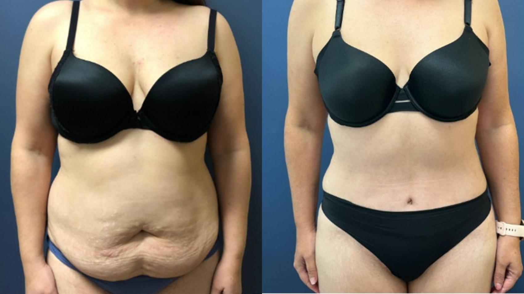 Tummy Tuck Before & After Photo | San Francisco, CA | Kaiser Permanente Cosmetic Services