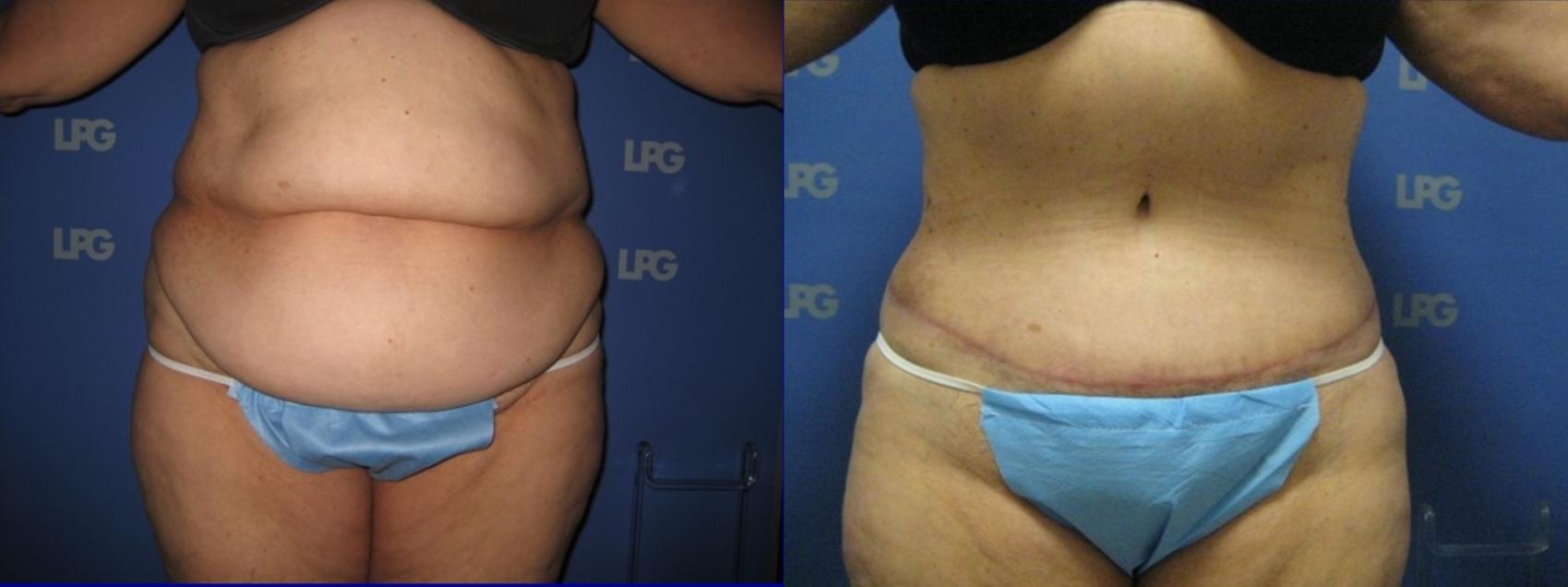 Tummy Tuck Before & After Photo | San Francisco, CA | Kaiser Permanente Cosmetic Services