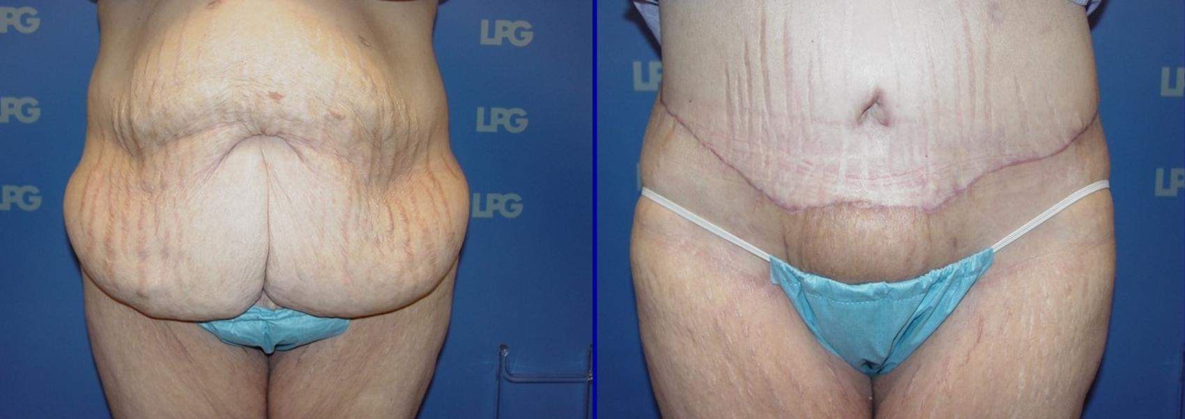 Tummy Tuck Before & After Photo | San Francisco, CA | Kaiser Permanente Cosmetic Services