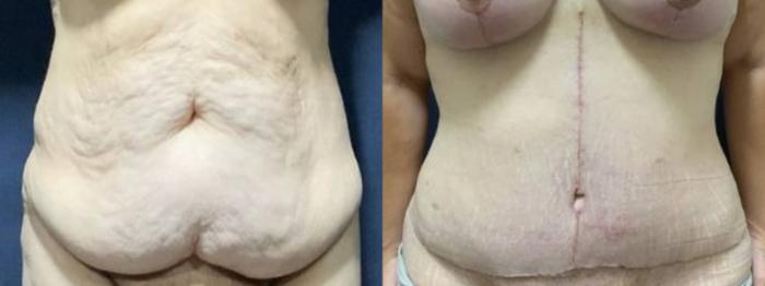 Tummy Tuck Before & After Photo | San Francisco, CA | Kaiser Permanente Cosmetic Services