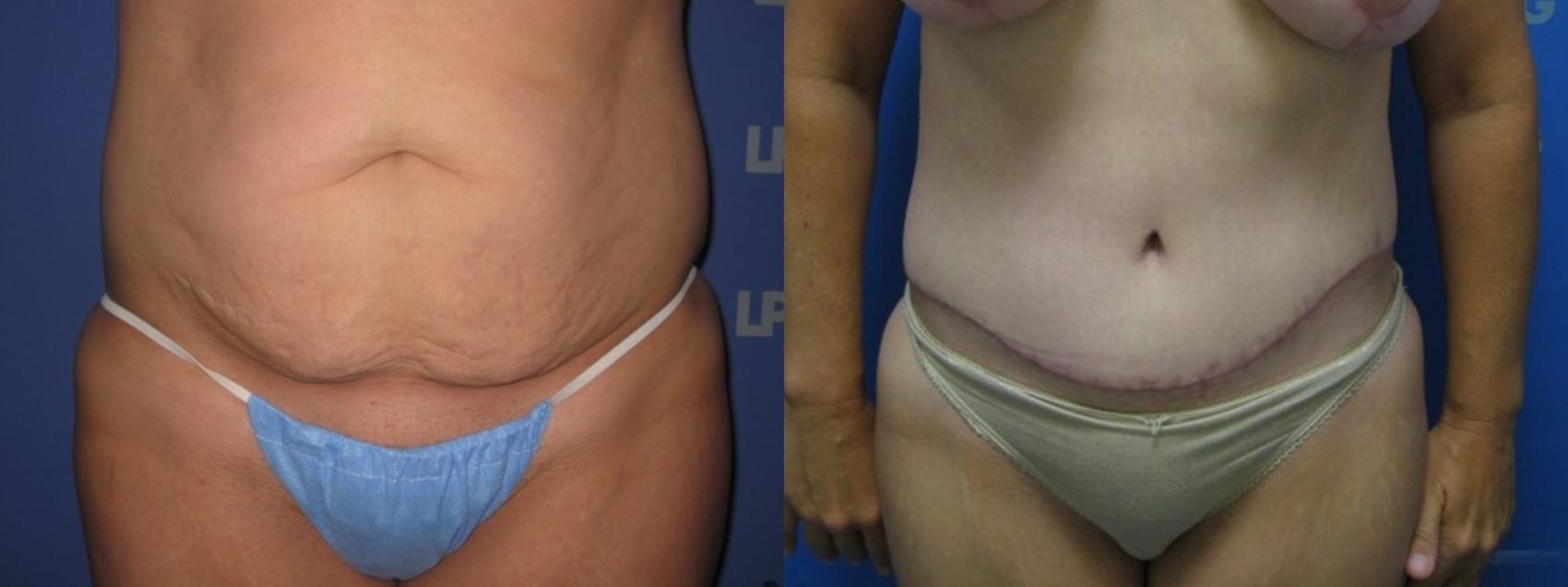 Tummy Tuck Before & After Photo | San Francisco, CA | Kaiser Permanente Cosmetic Services