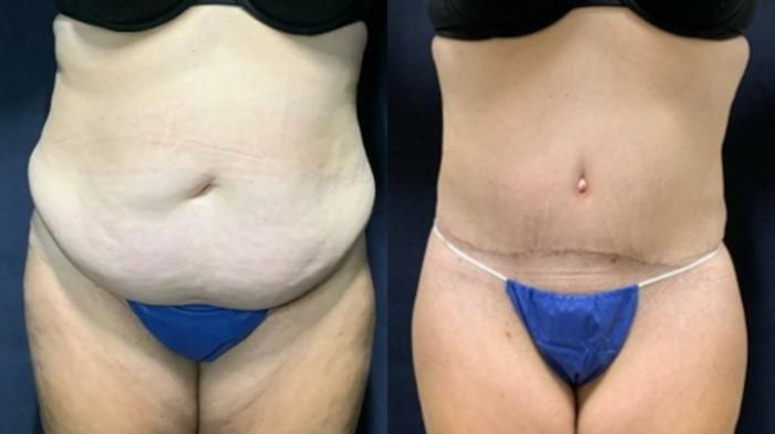 Tummy Tuck Before & After Photo | San Francisco, CA | Kaiser Permanente Cosmetic Services