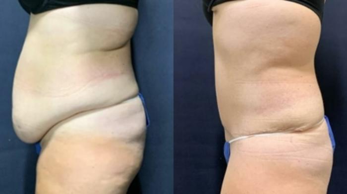 Tummy Tuck Before & After Photo | San Francisco, CA | Kaiser Permanente Cosmetic Services