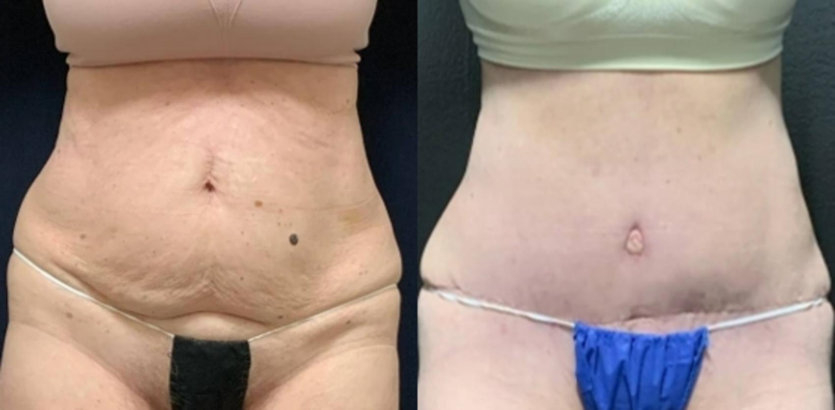 Tummy Tuck Before & After Photo | San Francisco, CA | Kaiser Permanente Cosmetic Services