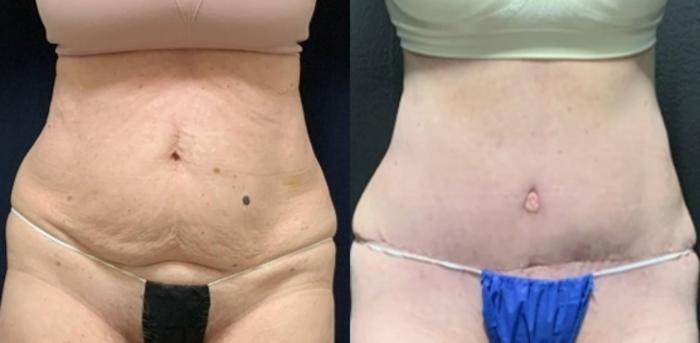 Tummy Tuck Before & After Photo | San Francisco, CA | Kaiser Permanente Cosmetic Services