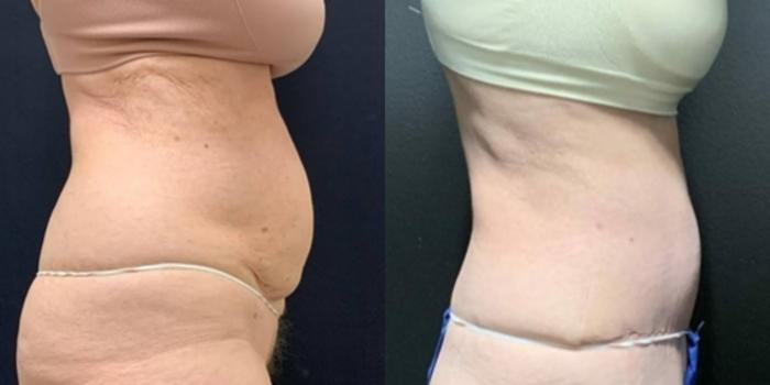 Tummy Tuck Before & After Photo | San Francisco, CA | Kaiser Permanente Cosmetic Services