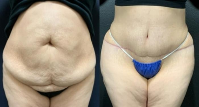 Tummy Tuck Before & After Photo | San Francisco, CA | Kaiser Permanente Cosmetic Services