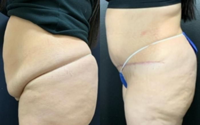 Tummy Tuck Before & After Photo | San Francisco, CA | Kaiser Permanente Cosmetic Services