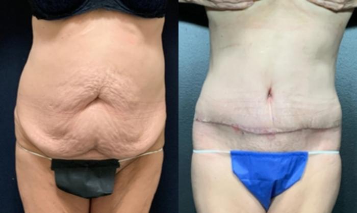 Tummy Tuck Before & After Photo | San Francisco, CA | Kaiser Permanente Cosmetic Services