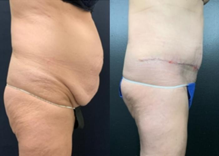 Tummy Tuck Before & After Photo | San Francisco, CA | Kaiser Permanente Cosmetic Services