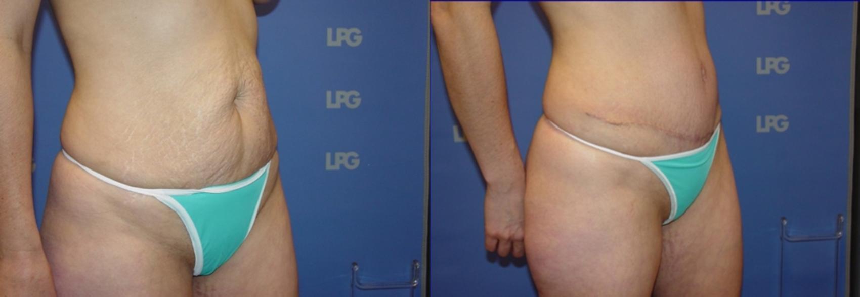 Tummy Tuck Before & After Photo | San Francisco, CA | Kaiser Permanente Cosmetic Services