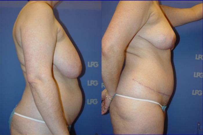 Tummy Tuck Before & After Photo | San Francisco, CA | Kaiser Permanente Cosmetic Services