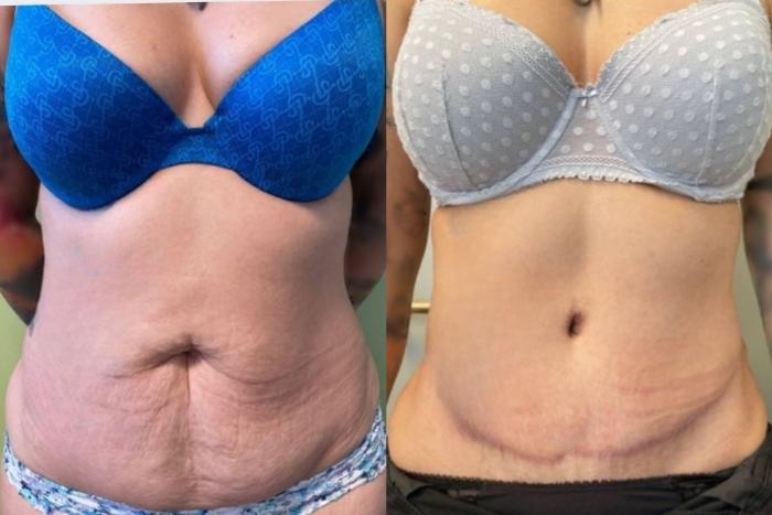 Tummy Tuck Before & After Photo | San Francisco, CA | Kaiser Permanente Cosmetic Services