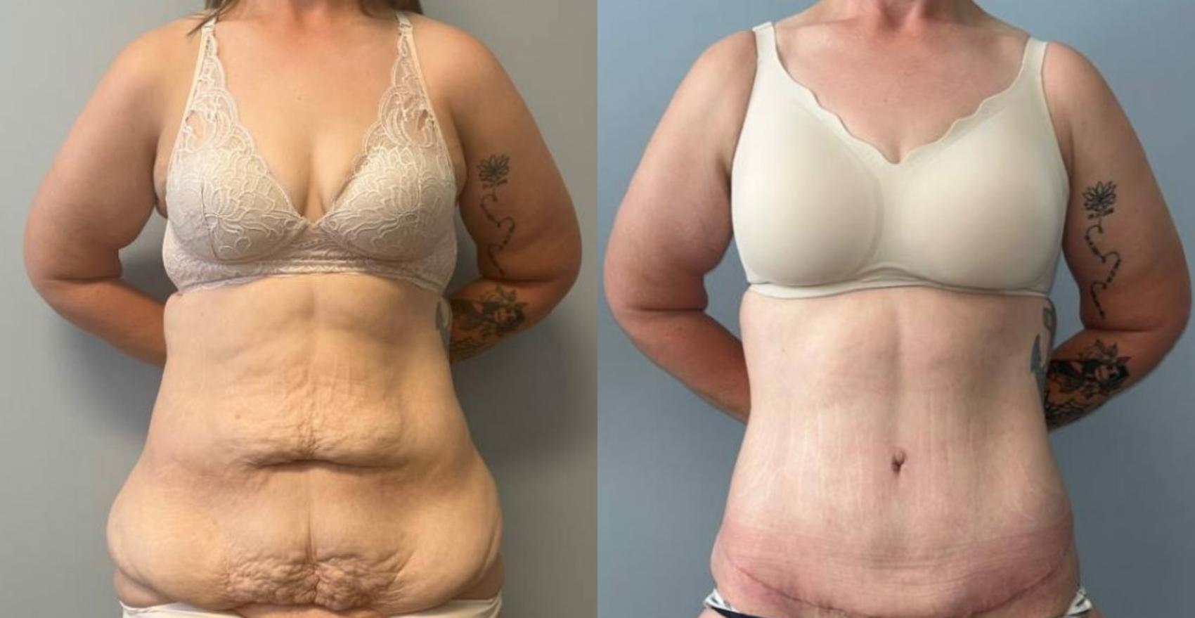 Tummy Tuck Before & After Photo | San Francisco, CA | Kaiser Permanente Cosmetic Services