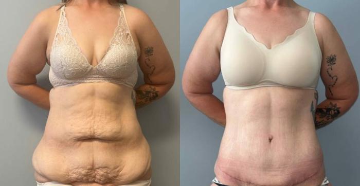 Tummy Tuck Before & After Photo | San Francisco, CA | Kaiser Permanente Cosmetic Services