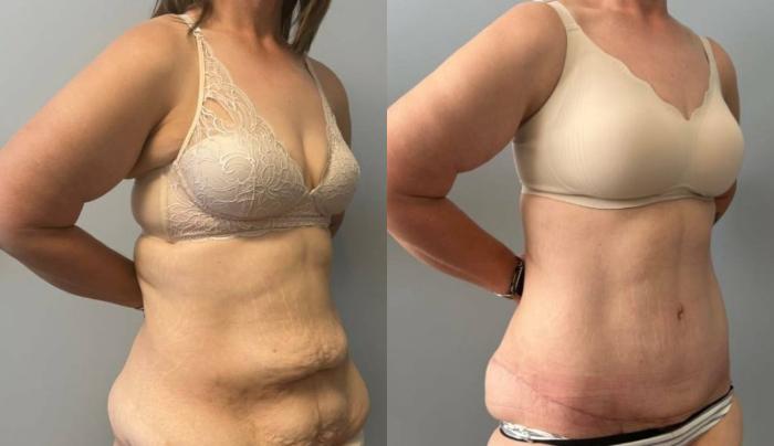 Tummy Tuck Before & After Photo | San Francisco, CA | Kaiser Permanente Cosmetic Services