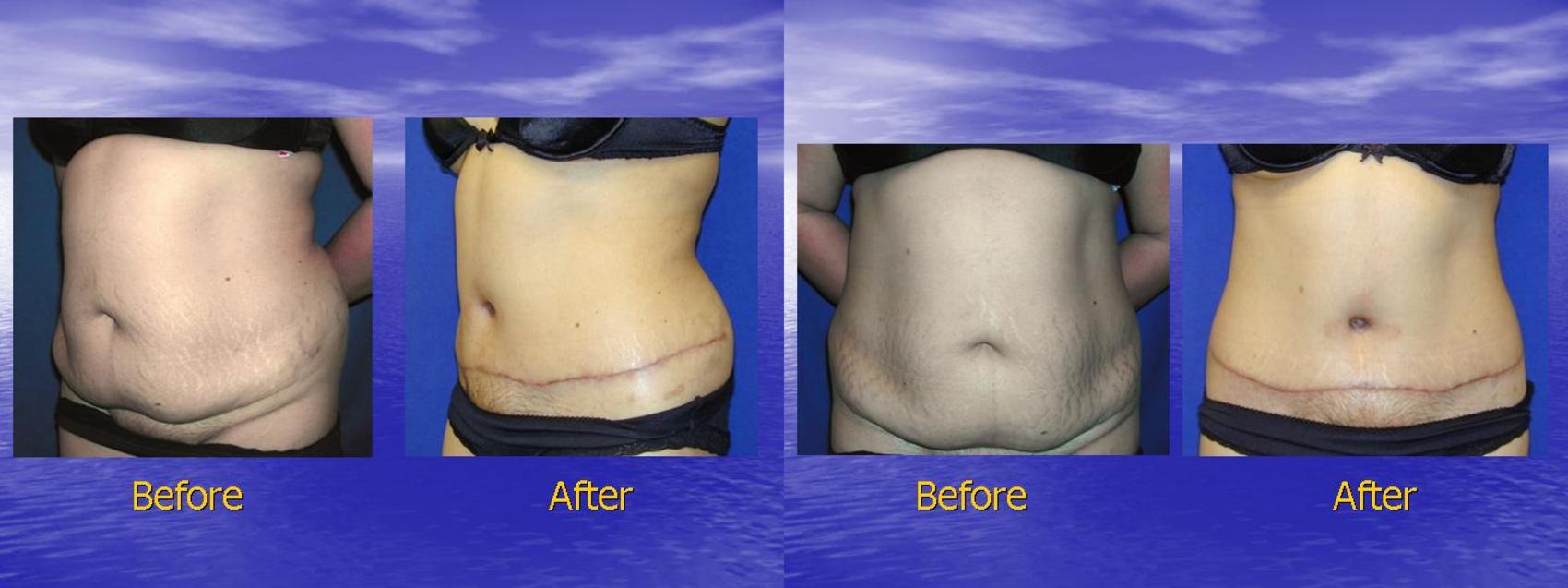 Amazing tummy tuck before and after surgery photos 4375