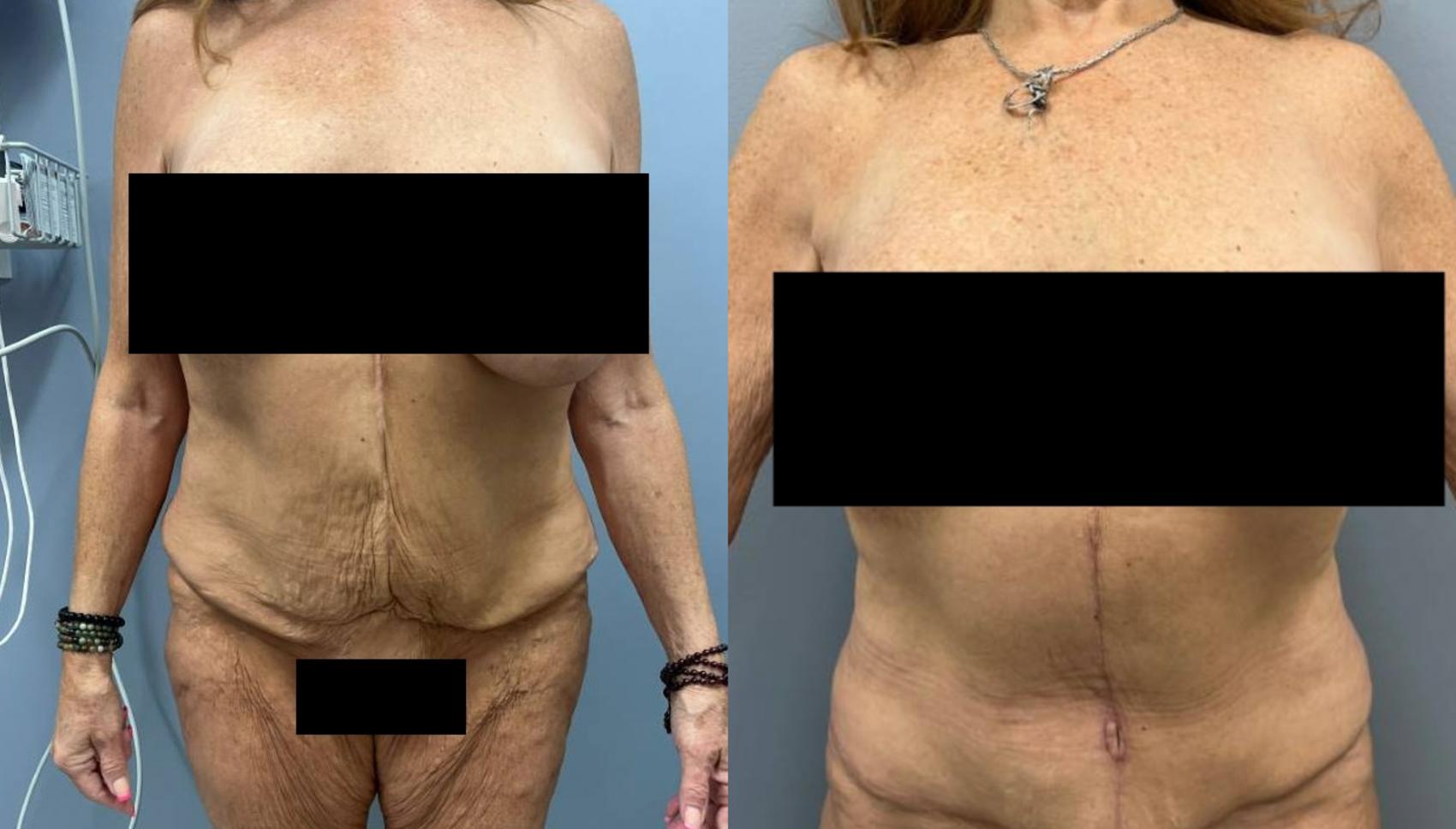 Tummy Tuck Before & After Photo | San Francisco, CA | Kaiser Permanente Cosmetic Services