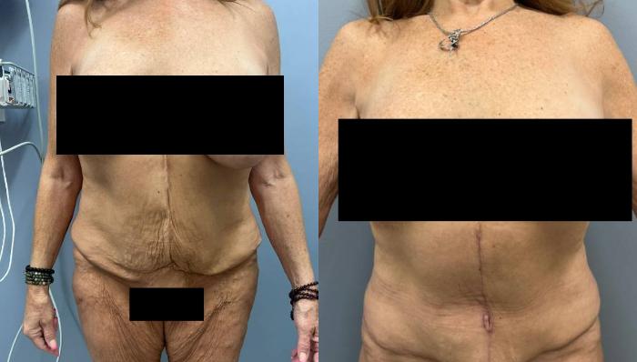 Tummy Tuck Before & After Photo | San Francisco, CA | Kaiser Permanente Cosmetic Services