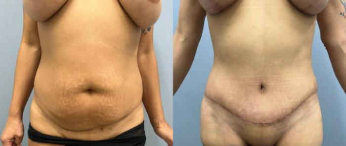 Tummy Tuck Before & After Photo | San Francisco, CA | Kaiser Permanente Cosmetic Services