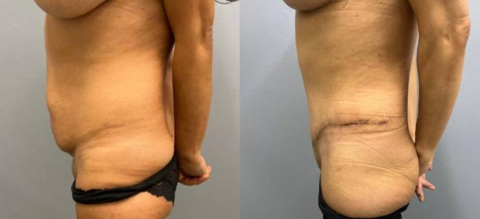 Tummy Tuck Before & After Photo | San Francisco, CA | Kaiser Permanente Cosmetic Services